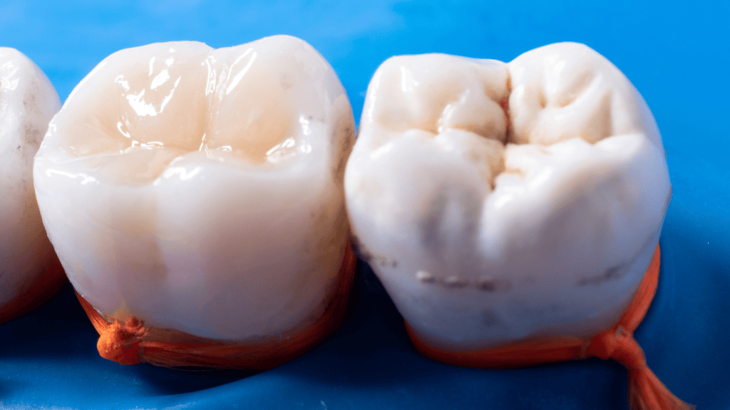 Tooth Fillings in NW Calgary