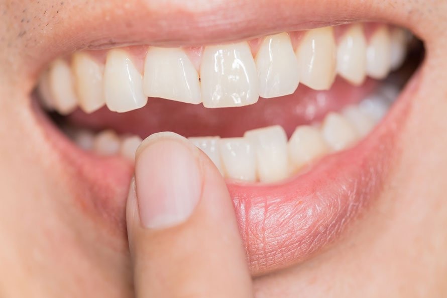 Can Dental Crowns Fix Cracked or Worn-Down Teeth?