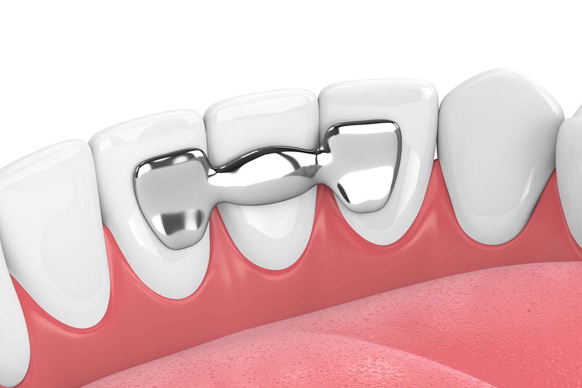 can a dental bridge replace a missing tooth
