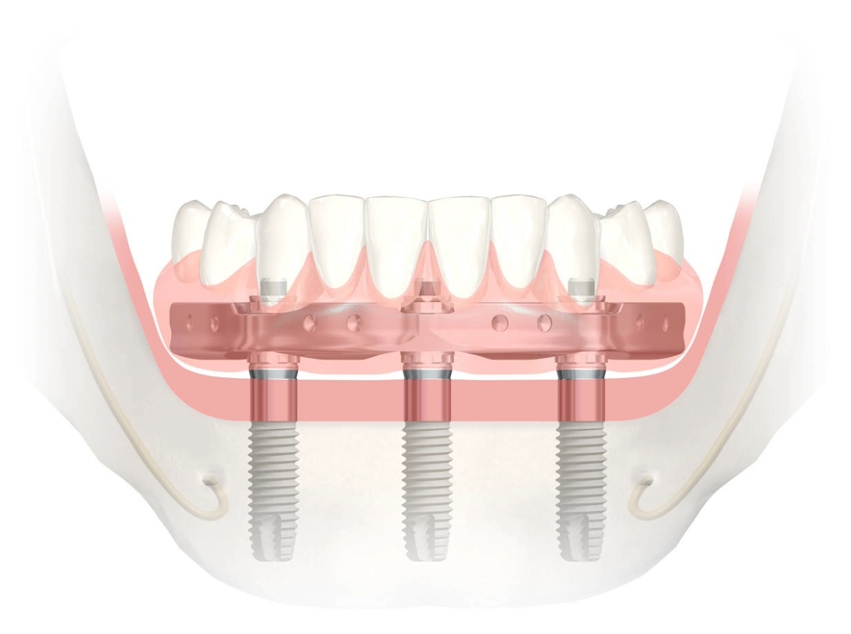 best denture option in nw Calgary Full partial or implant supported