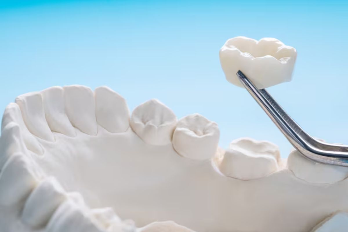 dental model with a ceramic crown illustrating treatment for damaged, broken, or decayed teeth